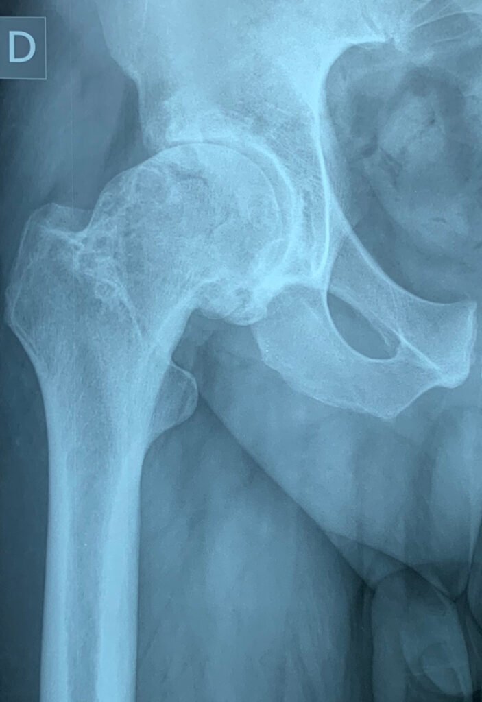 Artrosis de cadera derecha avanzada | Dra Lazzaitz Bergara
