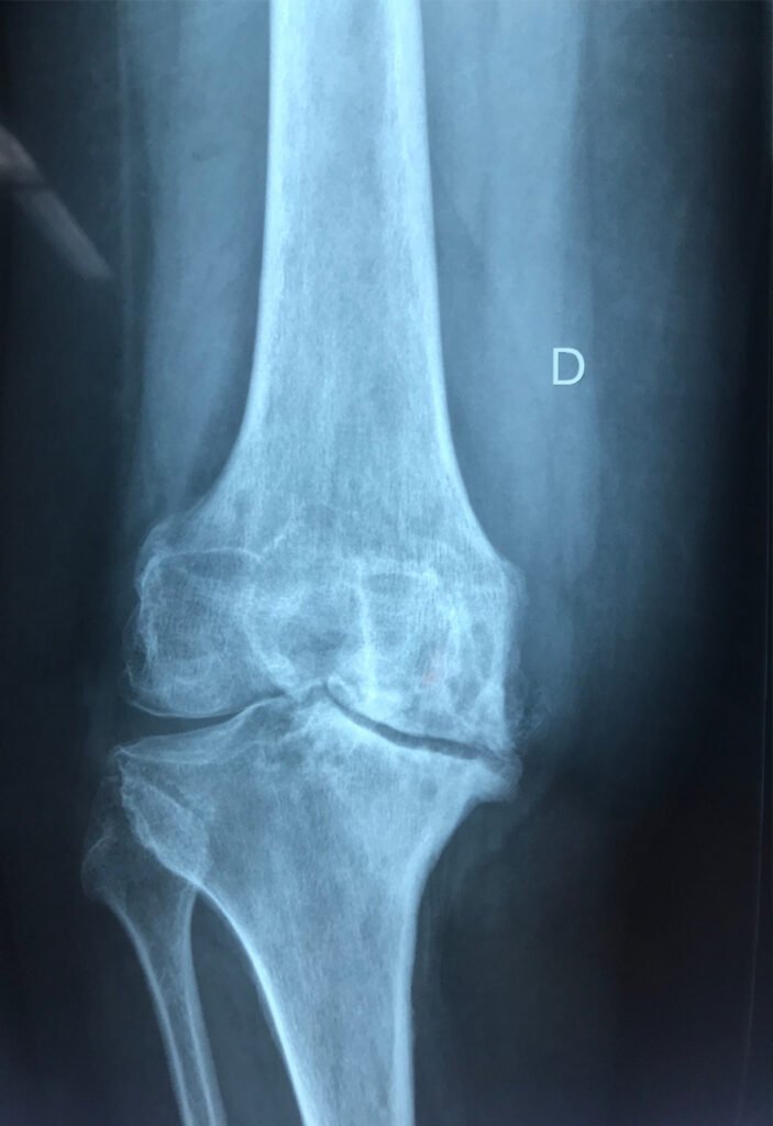 Artrosis de rodilla avanzada en proyeccion AP | Dra Lazzaitz Bergara