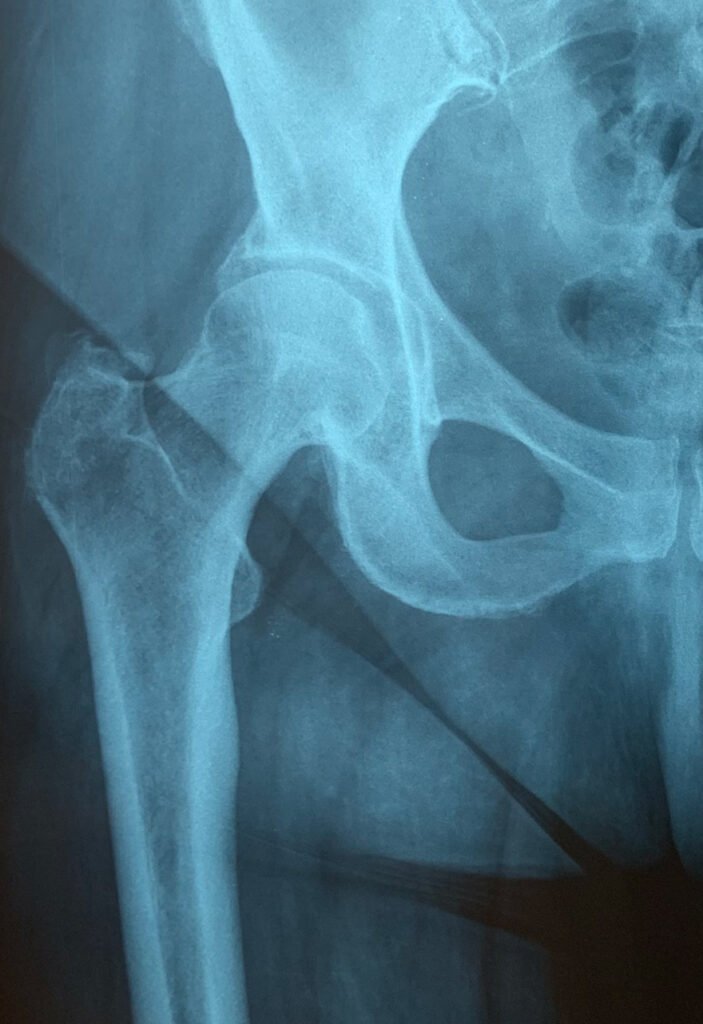 Cadera derecha sin artrosis | Dra Lazzaitz Bergara