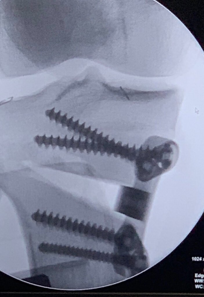 Radiografía de artrosis-rodilla-cirugia-OSTEOTOMIA-TIBIAL-