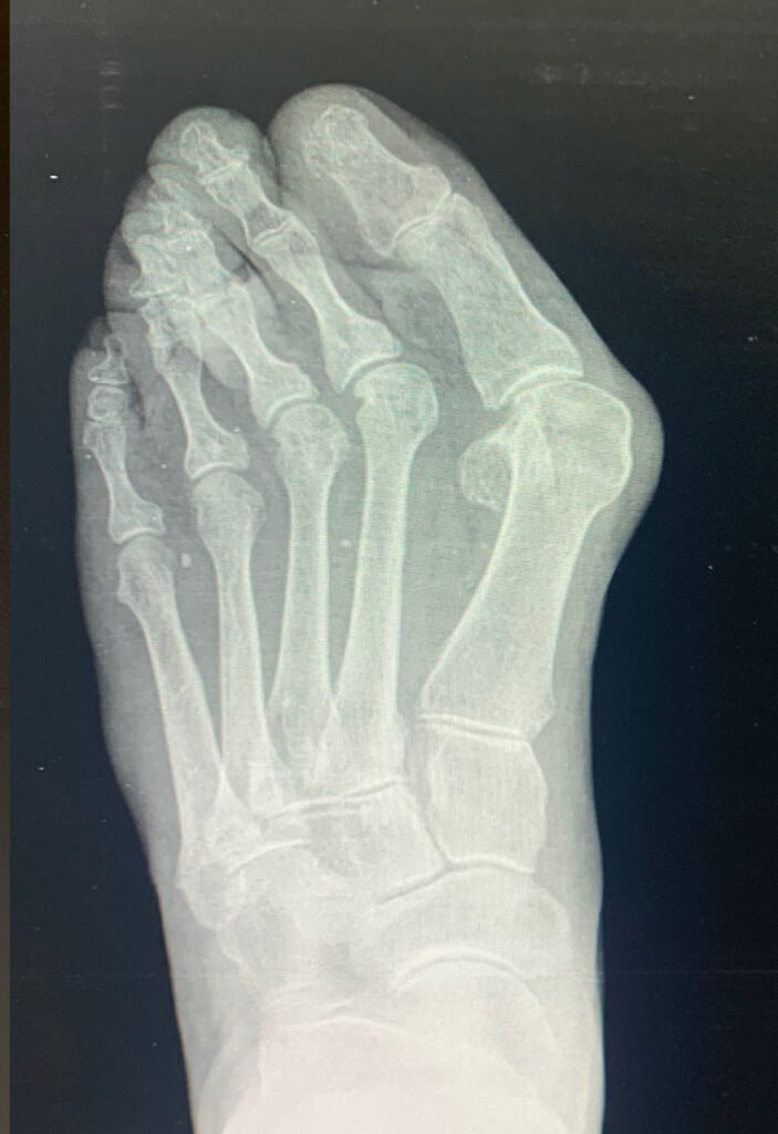 Radiografia de pies con juanete