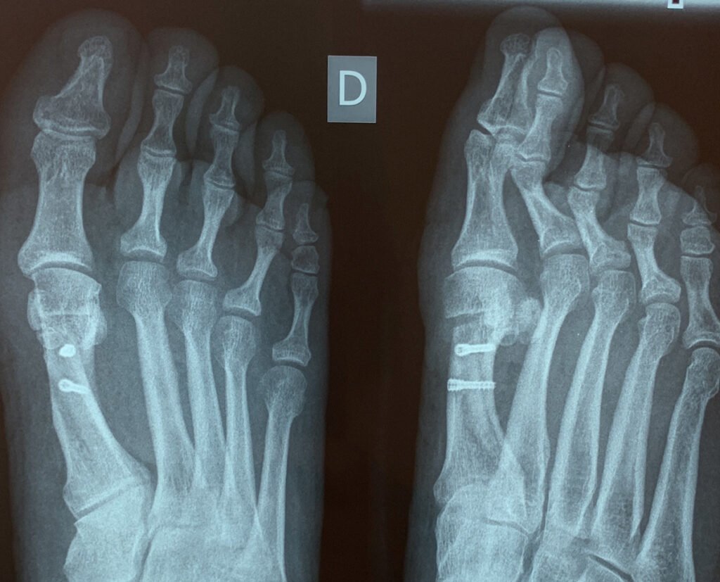 Radiografia de pies